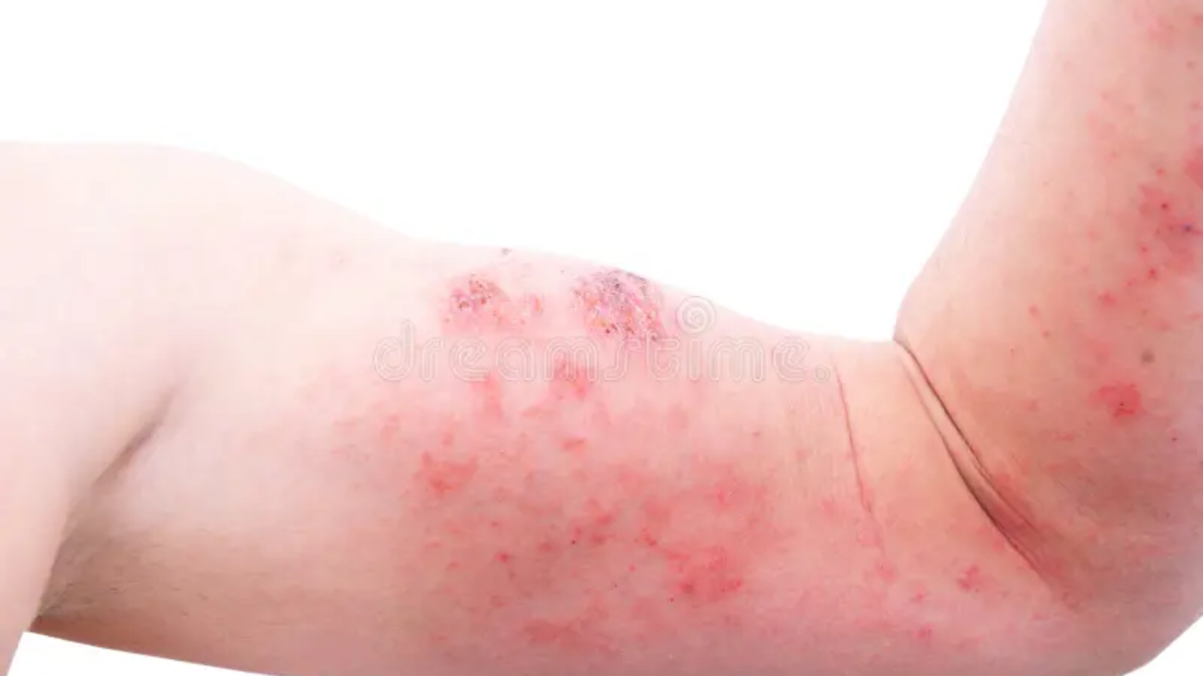 atopic-dermatitis-ad-also-known-as-atopic-eczema-type-inflammation-skin-dermatitis-foot-atopic-dermatitis-ad-175588755