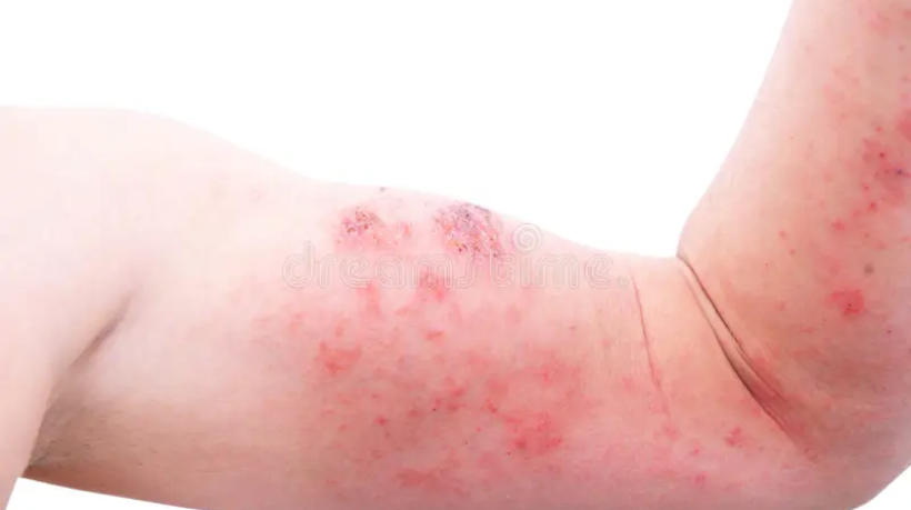 atopic-dermatitis-ad-also-known-as-atopic-eczema-type-inflammation-skin-dermatitis-foot-atopic-dermatitis-ad-175588755