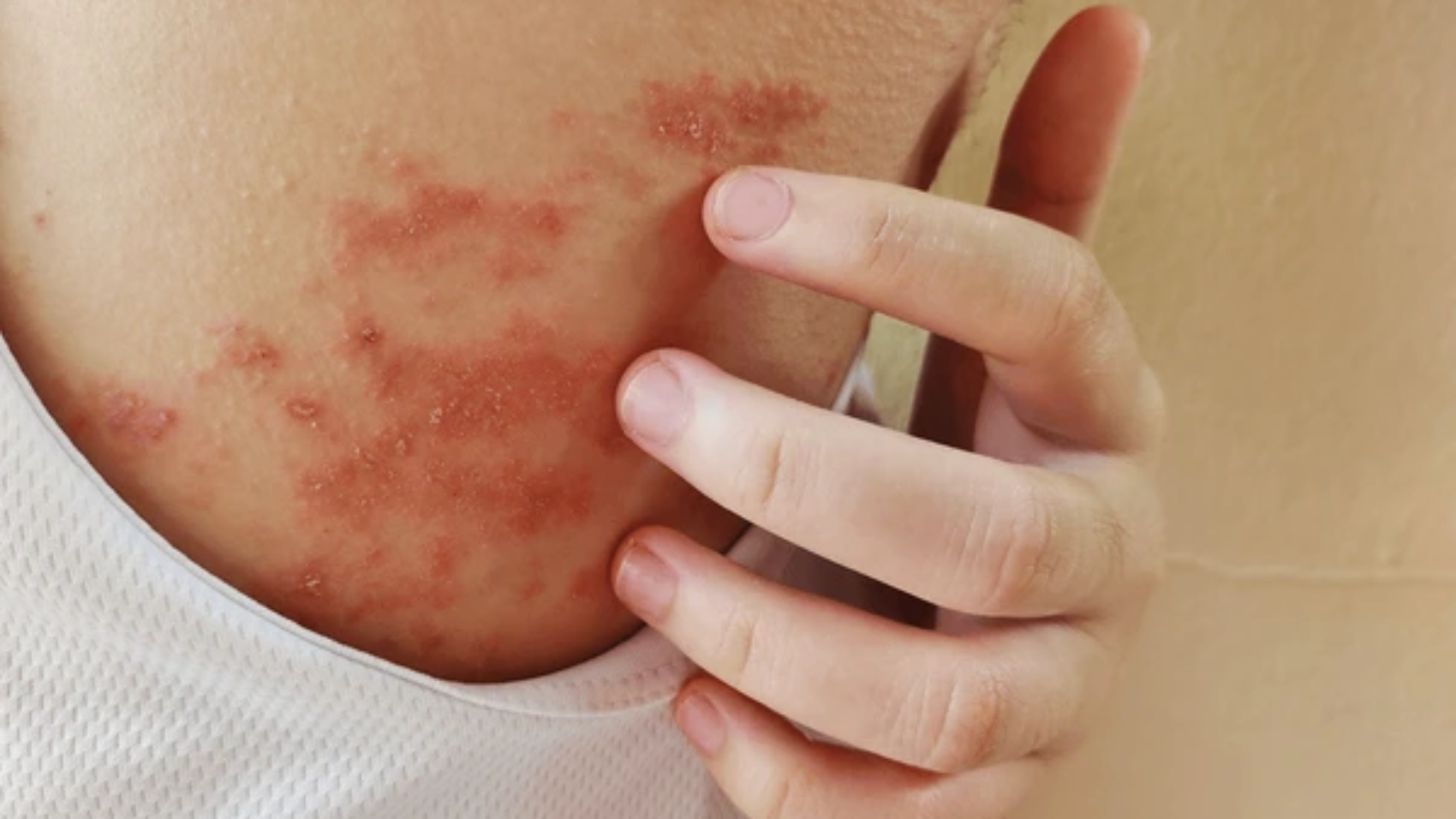 portrait-atopic-dermatitis-itchy-allergy-600nw-2509934483