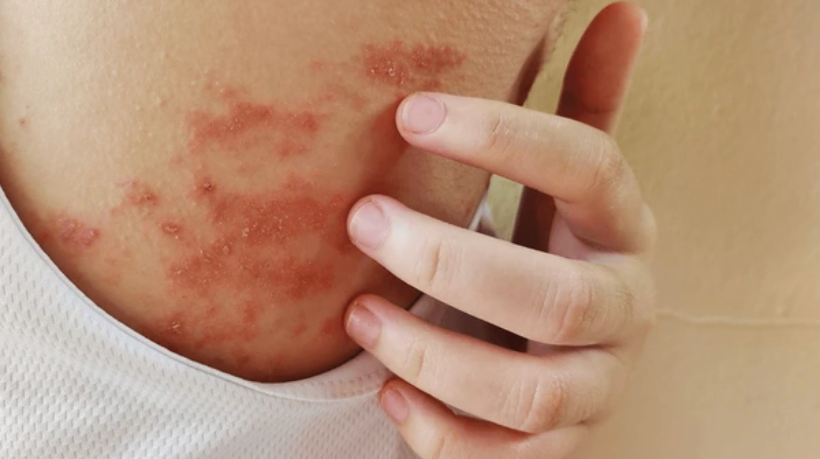 portrait-atopic-dermatitis-itchy-allergy-600nw-2509934483