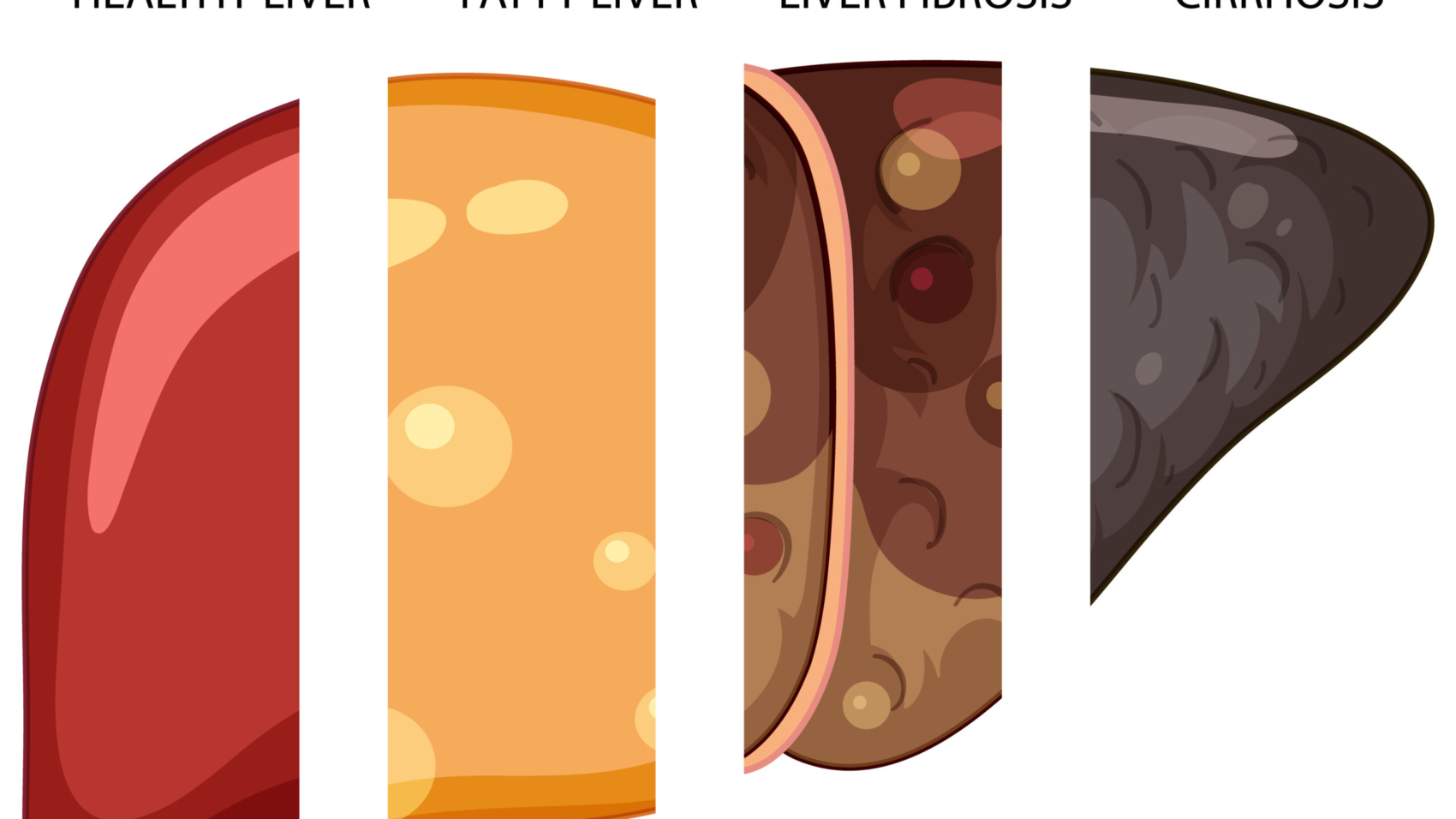 Diagram showing stages of liver damage illustration