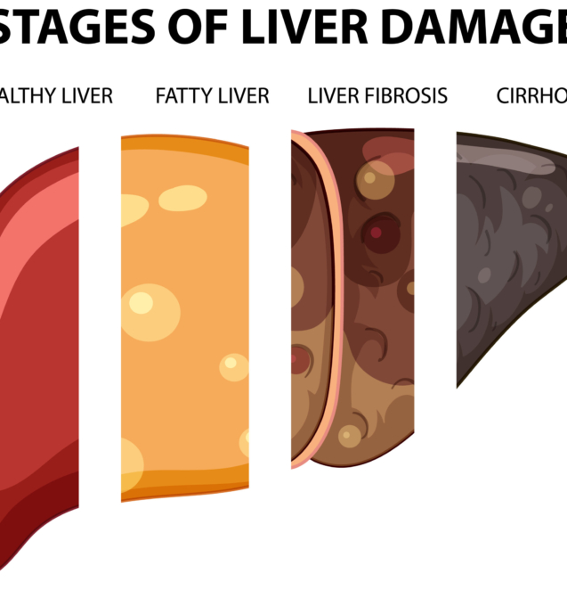 Diagram showing stages of liver damage illustration