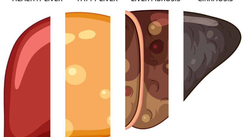 Diagram showing stages of liver damage illustration