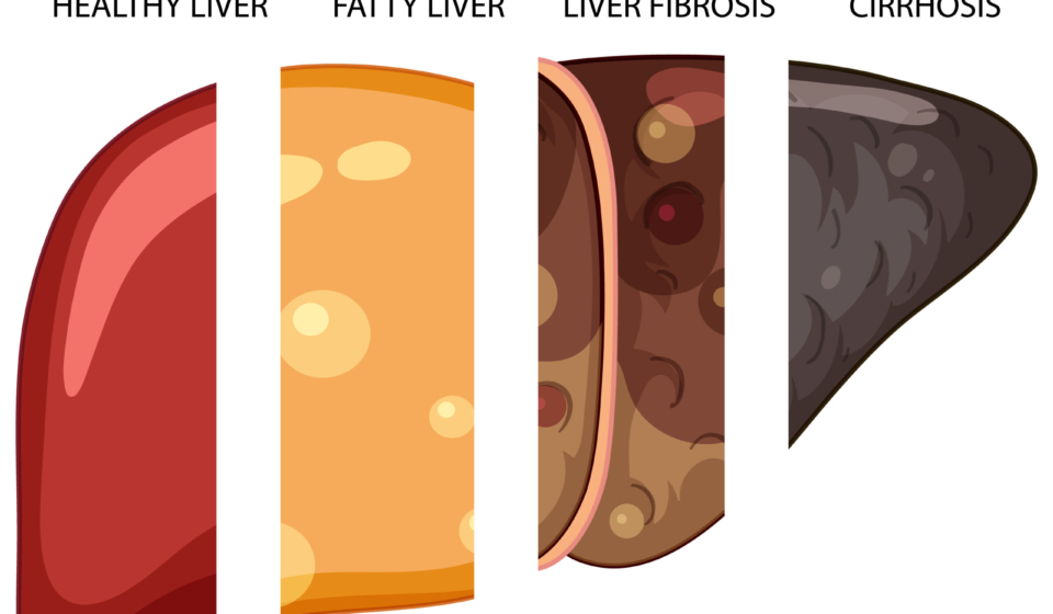 Diagram showing stages of liver damage illustration